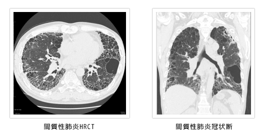 間質性肺炎HRCT/間質性肺冠状断