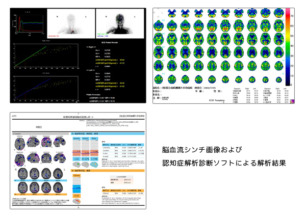脳血流シンチ画像および認知症解析診断ソフトによる解析結果