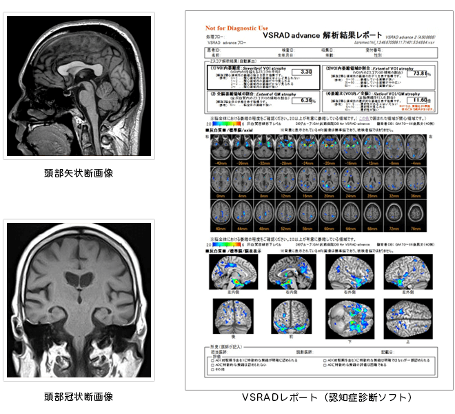 頭部矢状断画像・頭部冠状断画像・VSRADレポート(認知症診断ソフト)